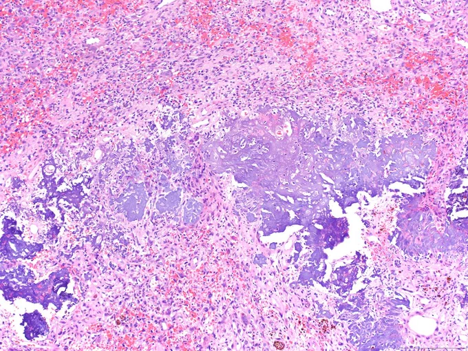 A 45-year-old female presents with severe muscle weakness, bone pain, and multiple fractures. Laboratory tests reveal profound hypophosphatemia. Spindle cell tumor with focal grungy calcification @IARCWHO