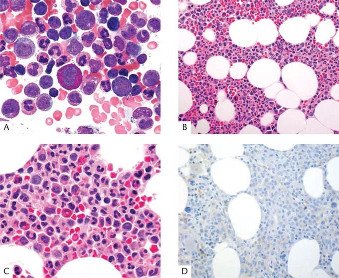 PURE RED CELL APLASIA:
Bone marrow aspirate showing a lack of nucleated RBCs (A). Bone marrow sections showing a lack of erythroid islands on H&E stains (B,C). Erythroid precursors are absent on a CD71 stain (D).
