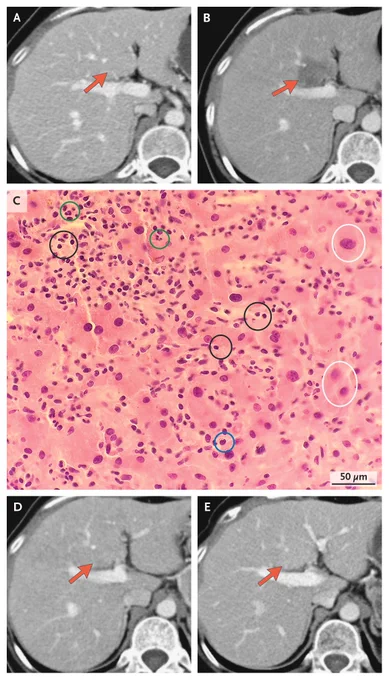 Panel A: A CT scan at baseline (May 2023).
Panel B: A CT scan that was obtained after two cycles of bulumtatug fuvedotin treatment (July 2023). 
Panel C: Hematoxylin and eosin staining of a liver-biopsy specimen obtained in July 2023 
Panel D: A follow-up CT scan 2 months later (September 2023) 
Panel E: A CT scan at long-term follow-up (October 2025).