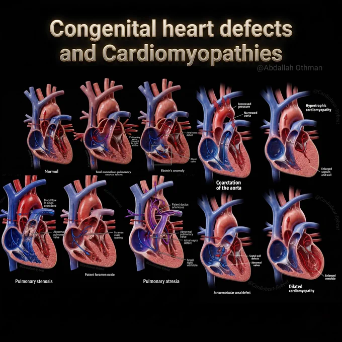 "High-resolution 3D medical illustration comparing 10 major congenital heart defects and cardiomyopathies on a black background. Includes Normal heart anatomy, Total anomalous pulmonary venous return, Ebstein’s anomaly, Coarctation of the aorta, Hypertrophic cardiomyopathy, Pulmonary stenosis, Patent foramen ovale, Pulmonary atresia, Atrioventricular canal defect, and Dilated cardiomyopathy. Detailed labels show key anatomical abnormalities, blood flow changes, and structural defects. Educational infographic for cardiology and medical education