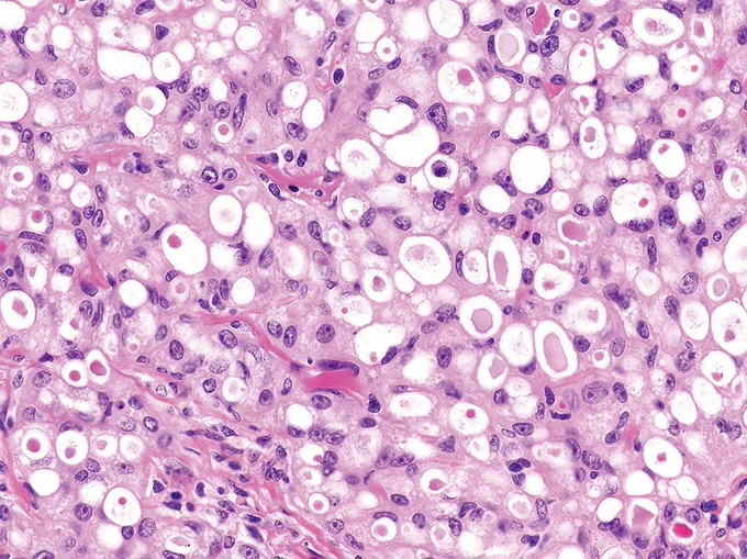 A 45-year-old female presents with a slow-growing, painless 15 mm nodule in the axilla. Bland neoplastic cells arranged in microcystic, tubular, and solid growth patterns with abundant secretion @IARCWHO