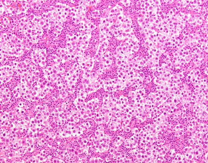 Fibrous septa between aggregates of tumor cells containing variable numbers of lymphocytes @IARCWHO