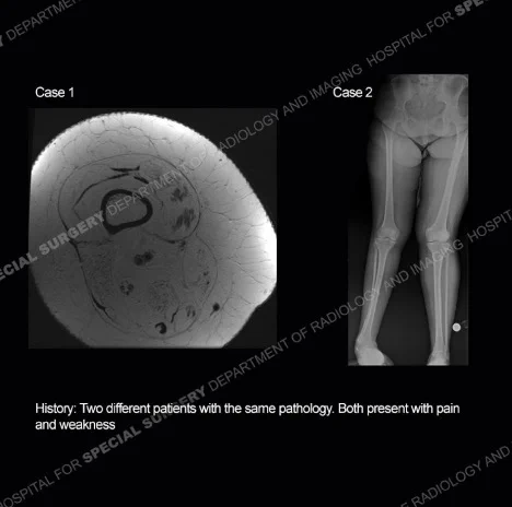 History: Two different patients with the same pathology. Both present with pain and weakness.