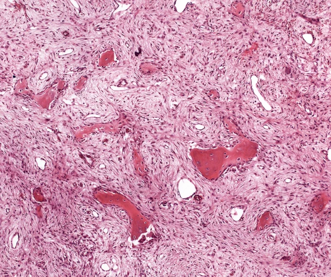 Woven bone with prominent osteoblastic rimming surrounded by spindle-shaped cells @IARCWHO