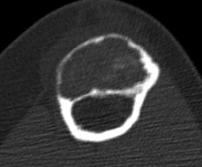 
Axial CT showing the tumor is confined to the cortex without medullary involvement @IARCWHO