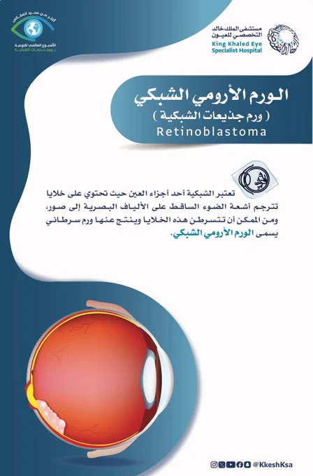 إنفو جرافيك عن الورم الأرومي الشبكي (Retinoblastoma) من مستشفى الملك خالد التخصصي للعيون  ومركز الأبحاث يحتوي على عنوان كبير باللغتين العربية والإنجليزية، مع شرح بأن شبكية العين تحتوي على خلايا تحول الضوء إلى صور، وأن تحول هذه الخلايا إلى خلايا سرطانية يؤدي إلى الإصابة بالورم الأرومي الشبكي. في الأسفل رسم تشريحي مقطعي لعين بشرية يظهر فيه الورم داخل الشبكية، مع تصميم بخلفية بيضاء وتدرجات زرقاء. في الأسفل يظهر حساب @KkeshKsa مع أيقونات وسائل التواصل الاجتماعي.