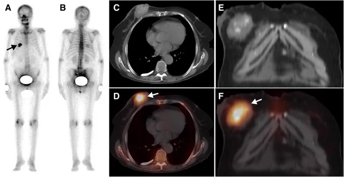 99mTc-MDP uptake in extraosseous neoplasm mimicking bone metastasis on whole-body bone scan: contribution of SPECT/CT