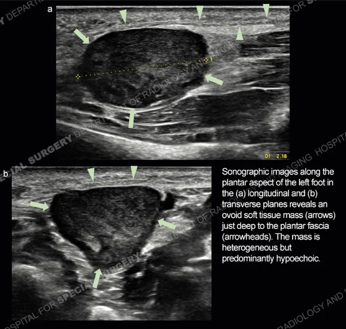 Sonographic images along the plantar aspect of the left foot in the (a) longitudinal and (b) transverse planes reveals an ovoid soft tissue mass (arrows) just deep to the plantar fascia (arrowheads). The mass is heterogeneous but predominantly hypoechoic.