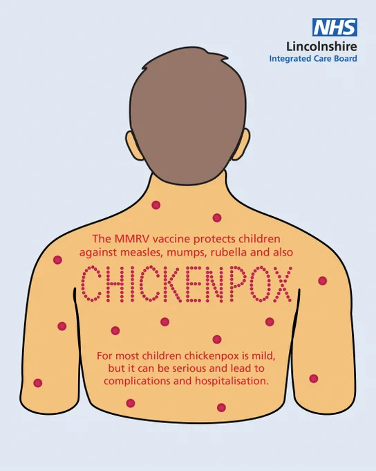Illustration of a person's back with red spots representing chickenpox, highlighting the importance of the MMRV vaccine for protection against measles, mumps, rubella, and chickenpox.