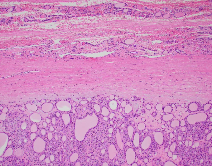 A 45-year-old man presents with a solitary, 2.5 cm, well-demarcated thyroid nodule. Encapsulated neoplasm showing a predominantly follicular growth pattern. @IARCWHO