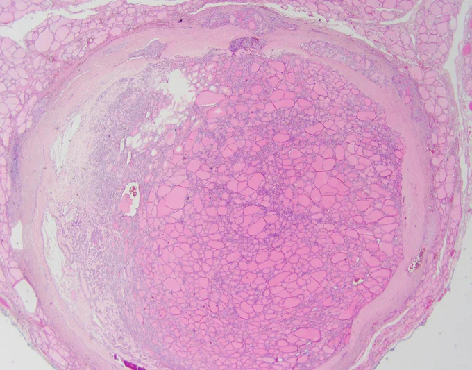 A 48-year-old woman presents with a solitary, well-demarcated thyroid mass. Capsular invasion. @IARCWHO