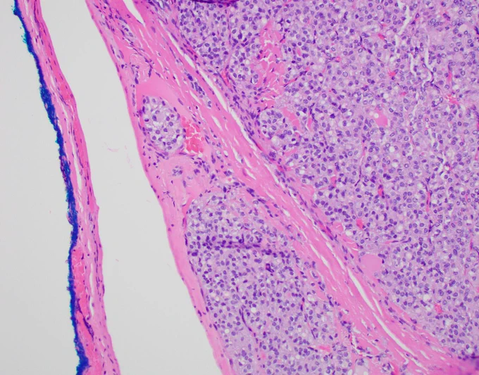 Note the unequivocal penetration through the thick fibrous capsule and into adjacent vascular spaces.