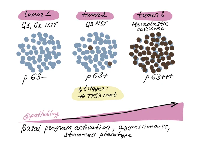 Illustrated diagram showing p63 expression across three breast tumor types. Tumor 1 (G1/G2 NST): uniformly blue cells, p63-negative. Tumor 2 (G3 NST): predominantly blue cells with scattered brown cells, p63-positive, triggered by TP53 mutation. Tumor 3 (Metaplastic carcinoma): predominantly brown cells, p63-strongly positive. An arrow along the bottom indicates increasing basal program activation, aggressiveness, and stem-cell phenotype from left to right.