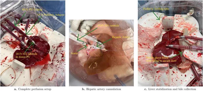 Figure 1 Normothermic machine perfusion setup for pediatric liver transplantation using the TransMedics OCS.