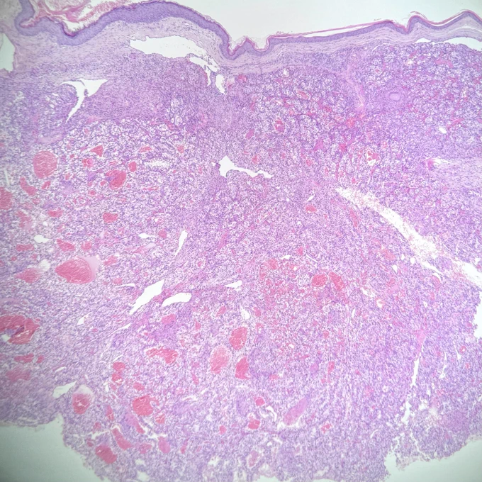 H&E staining. Skin biopsy: intact epidermis and a dermal tumor composed of clear cells, separated by a prominent network of thin-walled vessels.