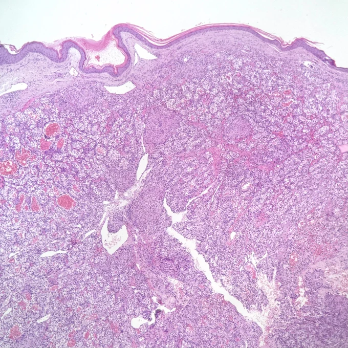 H&E staining. Skin biopsy: intact epidermis and a dermal tumor composed of clear cells, separated by a prominent network of thin-walled vessels.