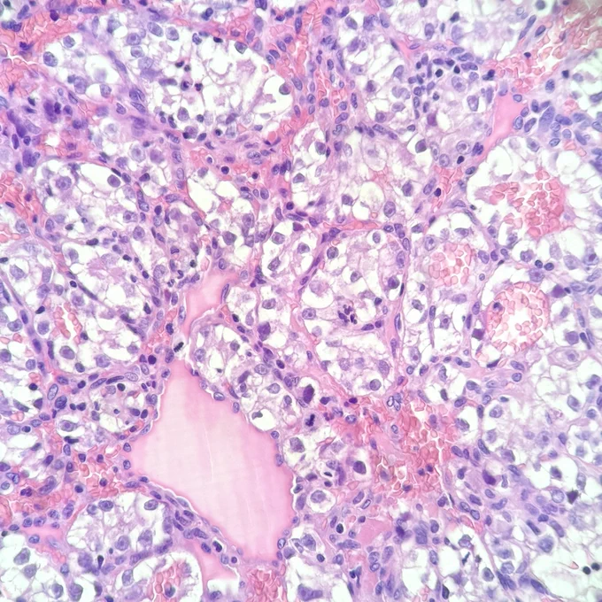 H&E stain. High-power view showing tumor cells with abundant clear cytoplasm and small, round, uniform nuclei. Thin-walled vessels are visible between tumor cell nests.