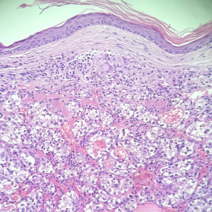 H&E stain. High-power view showing tumor cells with abundant clear cytoplasm and small, round, uniform nuclei. Thin-walled vessels are visible between tumor cell nests.