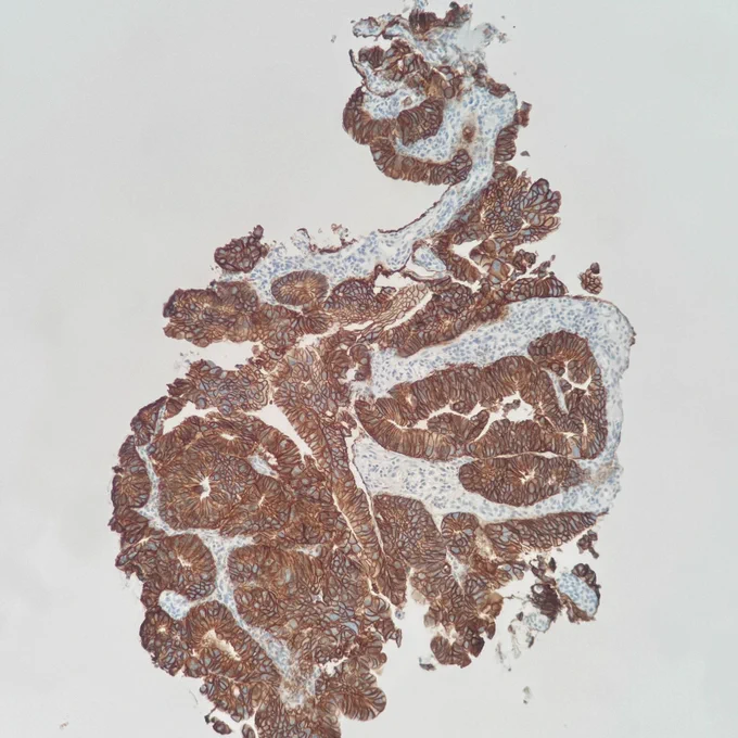colorectal adenocarcinoma with HER2 expression