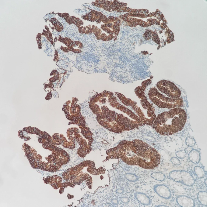 colorectal adenocarcinoma with HER2 expression