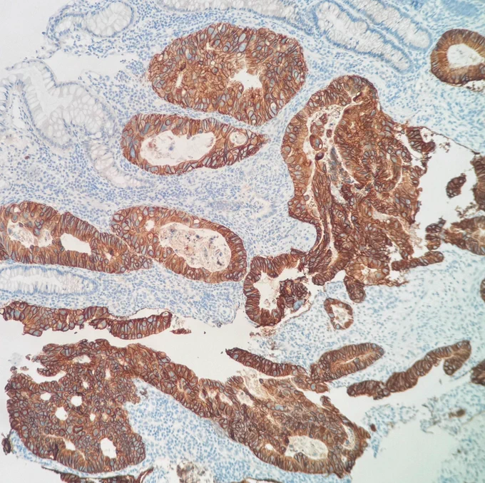 colorectal adenocarcinoma with HER2 expression