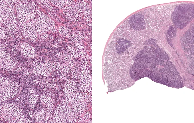 SEMINOMA
Left: A dense lymphocytic infiltrate is centered on fibrous septa.
Right: This seminoma shows separate, discontinuous nodules; variably prominent fibrous bands are in the largest nodule.