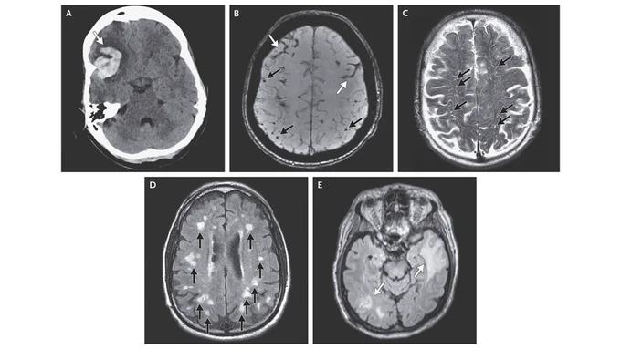 Neuroimaging features of cerebral amyloid angiopathy. 