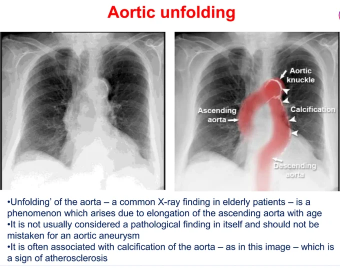 https://www.slideshare.net/slideshow/chest-xray-mediastinum-and-hilumpptxpptx/267632859