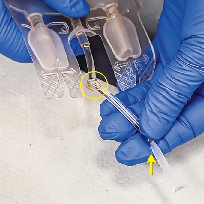 A photo of blood-bag tubes with single-knot closure.