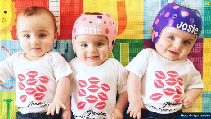 Three babies, two of which are wearing the U-M-designed bi-valve helmets.