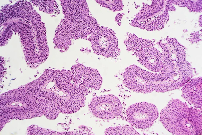  Microscopic view of a  papillary urothelial (transitional cell) carcinoma.