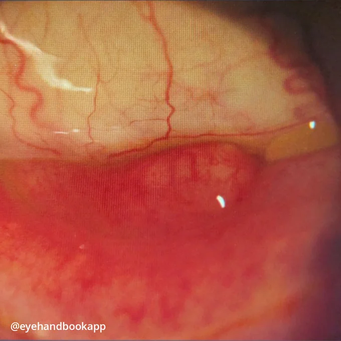 An 88-year-old female noticed a painless lump on her lower palpebral conjunctiva with an onset of about 1 week.

Make your job as an eye care professional easier with the #free Eye Handbook mobile app! Access calculators, forums, references, and information in seconds, right from your smartphone or tablet.

Available on Android & iOS:
https://onelink.to/eyehandbookapp