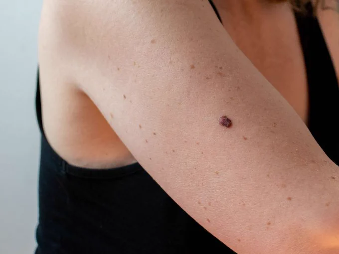 This image shows a close-up of a person's upper arm with a dark raised mole on the skin.