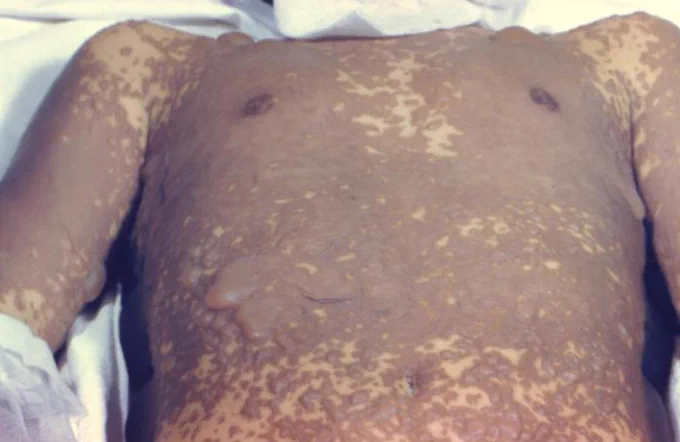 Measles rash on boy's chest