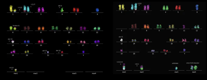 Two multicolor FISH karyograms of telomere-crisis NHA cells. Each chromosome is painted a distinct color and arranged in karyotype order, with extra marker chromosomes below. Labels point to numerous abnormalities, including several translocations and deletions; chromosome 13 is deleted in both cells.
