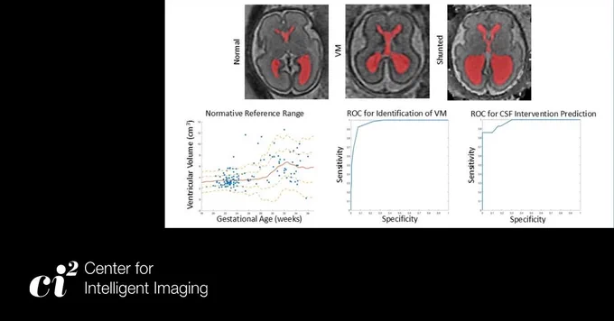 Brain scan images comparing normal, ventriculomegaly (VM), and shunted conditions. Graphs show ventricular volume against gestational age and ROC curves for VM identification and CSF intervention prediction. “Center for Intelligent Imaging” logo in the corner.