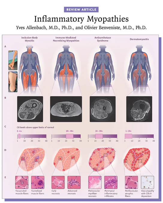 The image is a scientific illustration from a Review Article on inflammatory myopathies. It features a series of labeled diagrams and MRI images associated with different myopathy types. The diagrams show human figures with muscle weakness highlighted, and there are close-up images of muscle fibers under a microscope. The myopathy types include Inclusion-Body Myositis, Immune-Mediated Necrotizing Myopathies, Antisynthetase Syndrome, and Dermatomyositis. Diagnostic markers and affected areas are indicated.