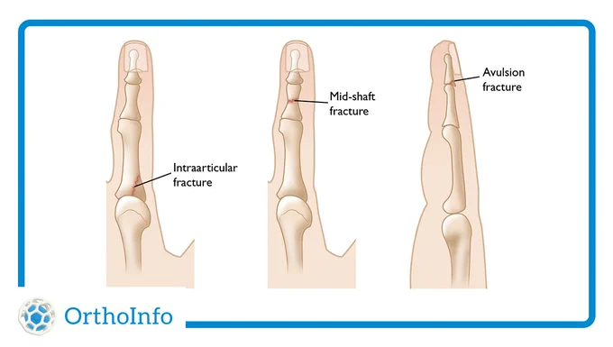 Illustration Showing Different Types of Finger Fractures