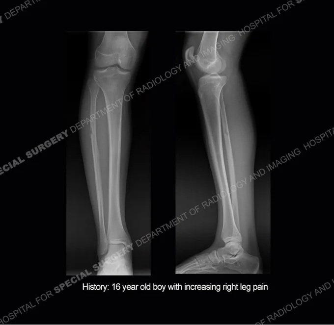 History: 16-year-old boy with increasing right leg pain.