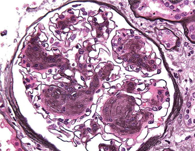 NODULAR DIABETIC GLOMERULOSCLEROSIS:
Several large Kimmelstiel-Wilson mesangial nodules are present throughout this glomerular tuft. (JMS stain)