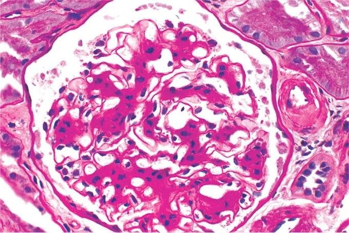 DIFFUSE DIABETIC GLOMERULOSCLEROSIS:
There is global widening of the glomerular mesangial regions. Moderate to marked enlargement of the glomeruli may be visible. These changes in this glomerulus are representative of the changes in all glomeruli, thus the term “diffuse” glomerulosclerosis. There is also accompanying arteriolosclerosis. (Periodic acid–Schiff [PAS] stain)