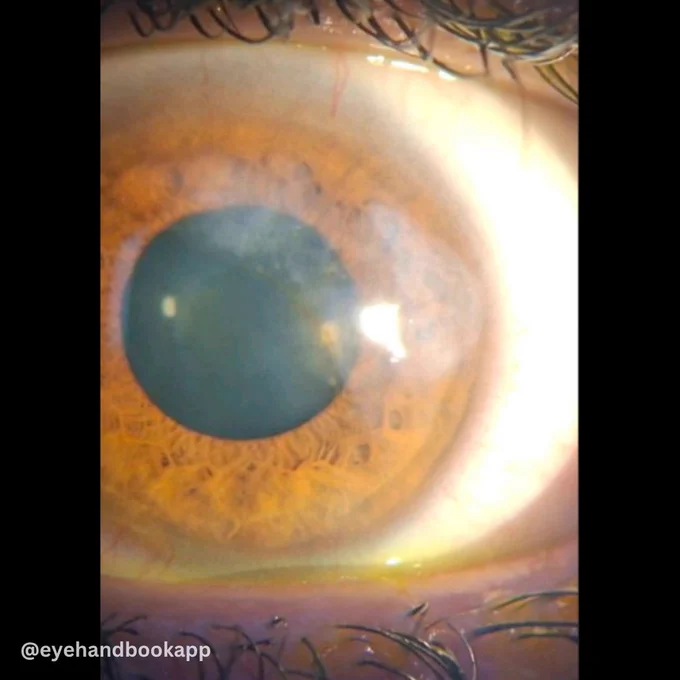 Corneal opacity: A 29-year-old Caucasian male with a 5-year history of corneal opacities, previously treated for Varicella zoster virus infection, presents with a 2-week history of blurred vision and paresthesia involving the eyelid and cheek.

Make your job as an eye care professional easier with the #free Eye Handbook mobile app! Access calculators, forums, references, and information in seconds, right from your smartphone or tablet.
Available on Android & iOS:
https://onelink.to/eyehandbookapp