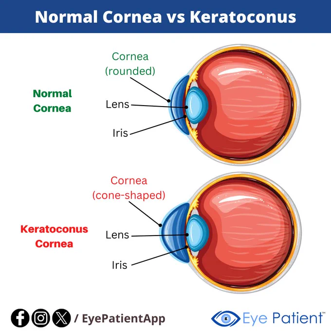 Learn about your eyes through our extensive library, find an eye care professional near you, and monitor your vision with convenient tools on the #free Eye Patient app.

Available on Android & iOS:
https://onelink.to/eyepatientapp