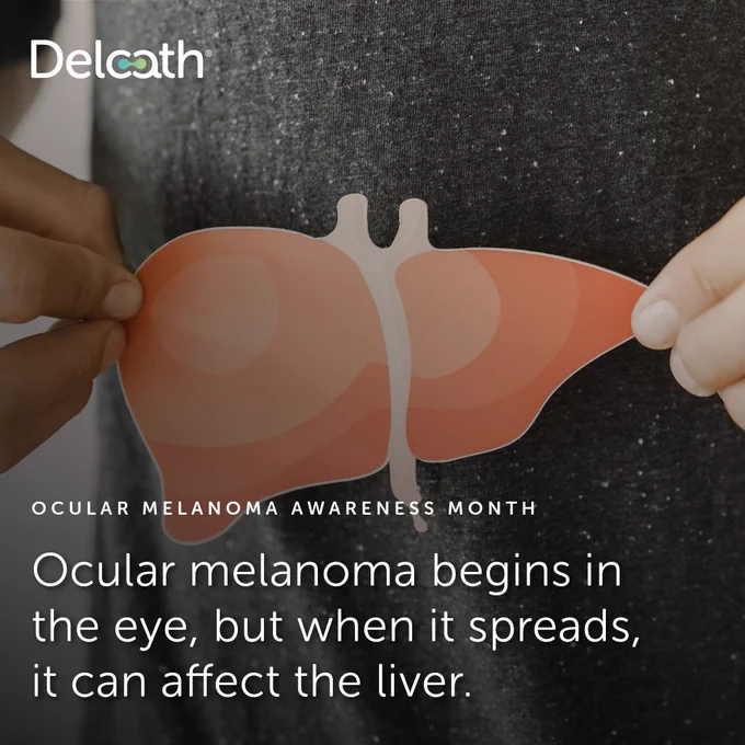 Delcath awareness graphic for Ocular Melanoma Awareness Month showing hands holding a liver illustration against a dark background. Text reads: “Ocular melanoma begins in the eye, but when it spreads, it can affect the liver.”