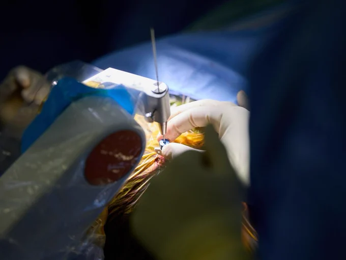 A person undergoing a LITT (Laser Interstitial Thermal Therapy) procedure. A precision tool is positioned over the patient's head. The scene includes gloved hands assisting with the procedure, all under bright surgical lighting.