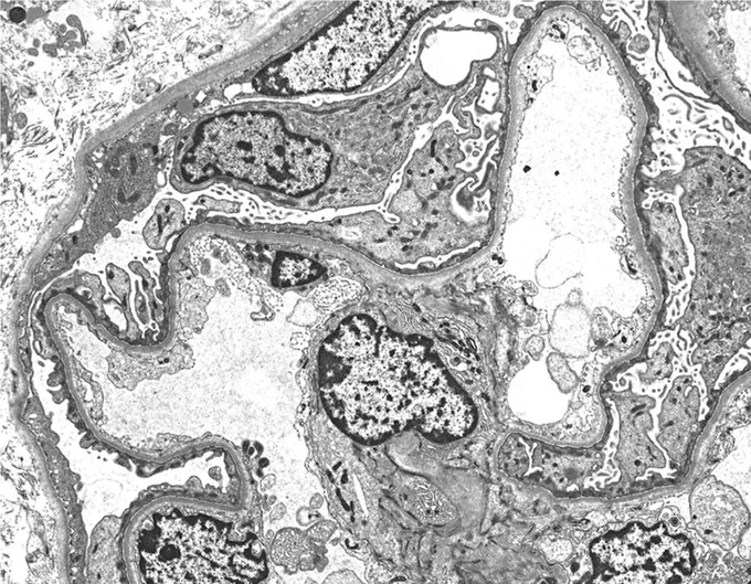 MINIMAL CHANGE DISEASE:
By electron microscopy, there is extensive foot process effacement (or fusion), with hypertrophy of the podocyte cell bodies. The primary processes are intact and form slender cytoplasmic extensions from the cell bodies to the foot processes. The glomerular basement membranes appear normal in thickness, without electron-dense deposits.