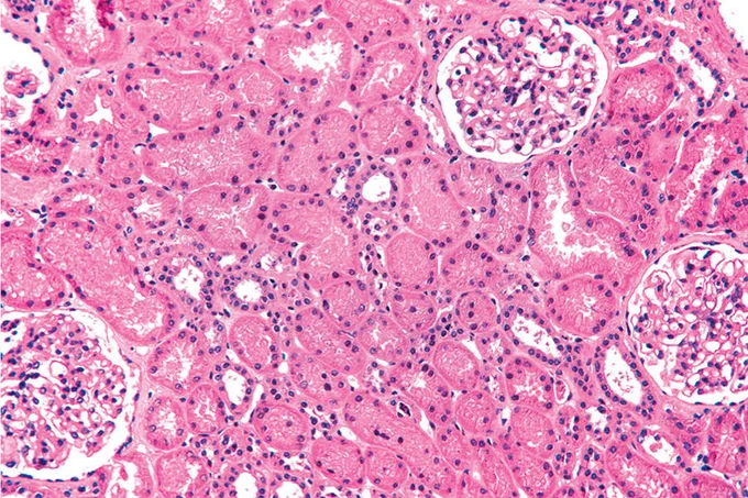 MINIMAL CHANGE DISEASE:
Low-power view of the kidney, showing no detectable histologic abnormalities. (Hematoxylin and eosin [H&E] stain)