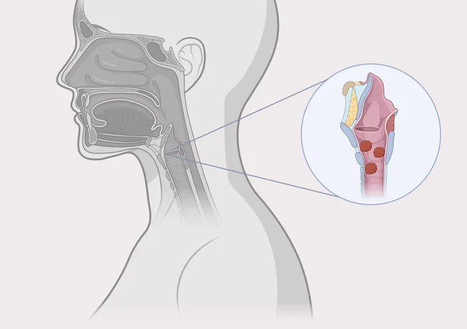 An illustration of papillomas in the throat, caused by recurrent respiratory papillomatosis (RRP). Newly approved Papzimeos is the first non-surgical treatment for RRP. Credit: Image created by Linda Wang with BioRender.