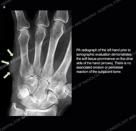 PA radiograph of the left hand prior to sonographic evaluation demonstrates the soft tissue prominence on the ulnar side of the hand (arrows). There are no associated erosion or periosteal reaction of the subjacent bone.