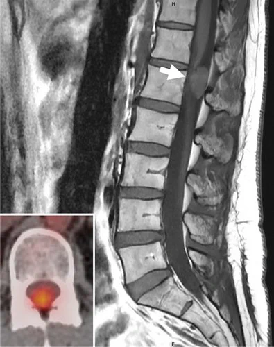 Sagittal T1-weighted post-contrast MRI scan of the spine showed a solid, intradural, extramedullary mass at the L1 level (white arrow). Inset: Axial PET-CT demonstrated increased tracer uptake in the spinal canal.